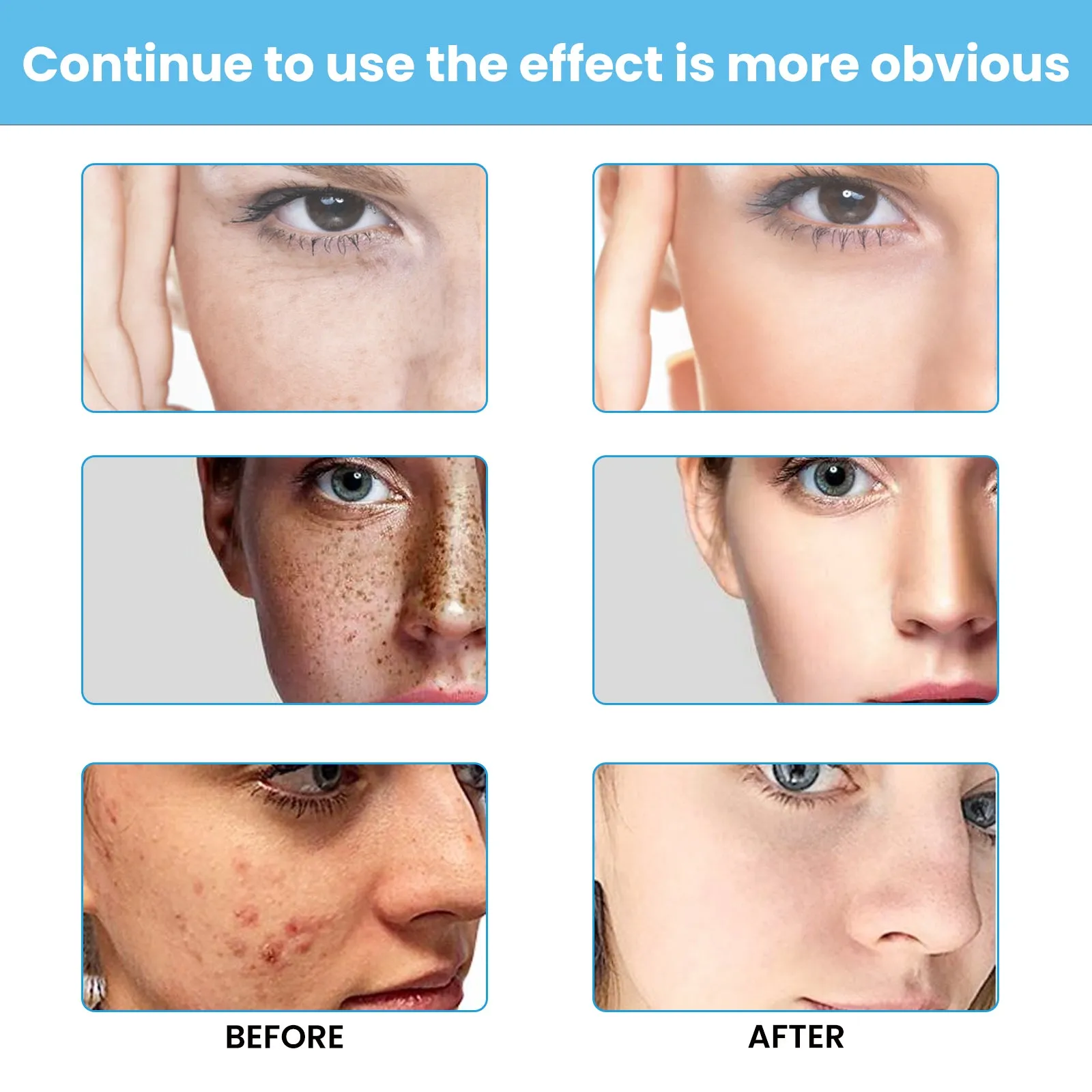 EELHOE™ Dark Spot and Acne Treatment Lotion